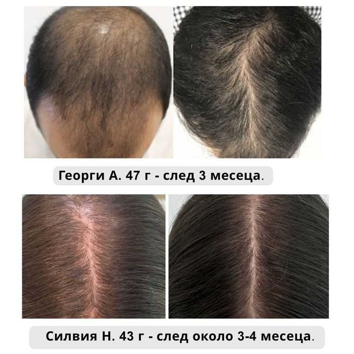 крем против алопеция