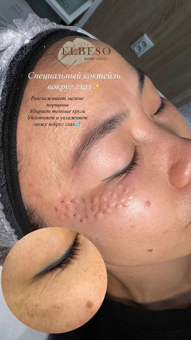 Плазмалифтинг, увеличение губ