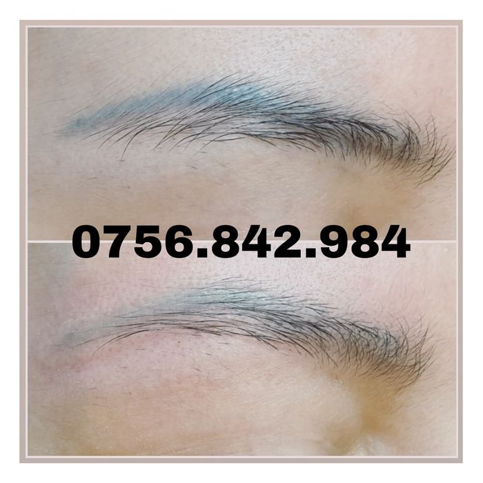 Arad-Eliminare tatuaj cu laser, preturi de la 100 ron