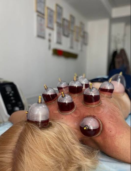 Хиджама сухой хиджама пиявки zuluk