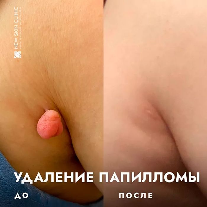 Акция!Удаление папиломы от 25 тысяч