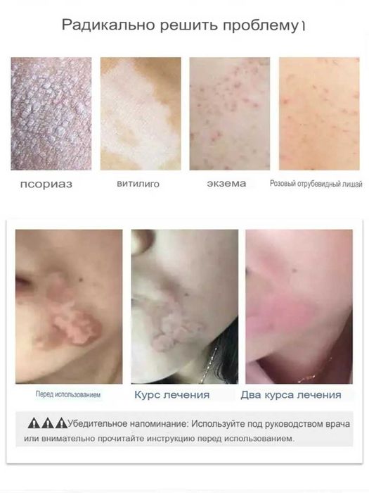 Ультрафиолетовый терапевтический прибор 311 нм для витилиго и псиораза