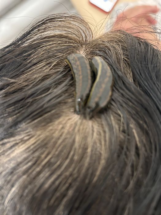 Лечение пиявками Гирудотерапия