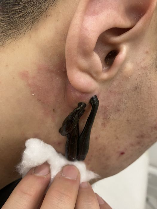 Лечение пиявками Гирудотерапия