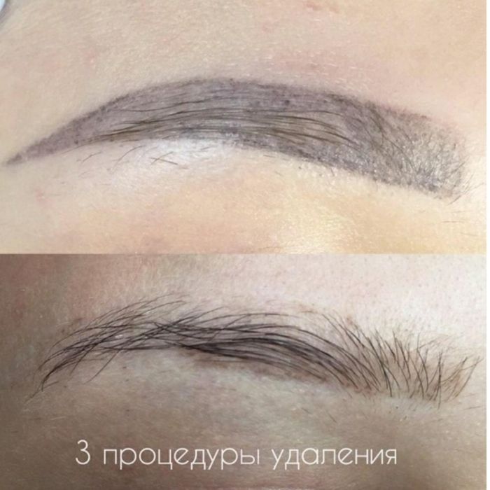 Nd YAG Удаление Татуажа и Татуировки! Мощный лазер!