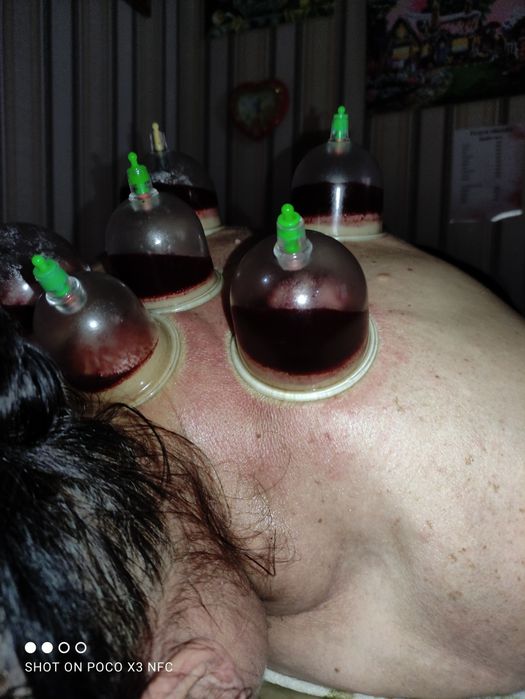 Баночный массаж хиджама