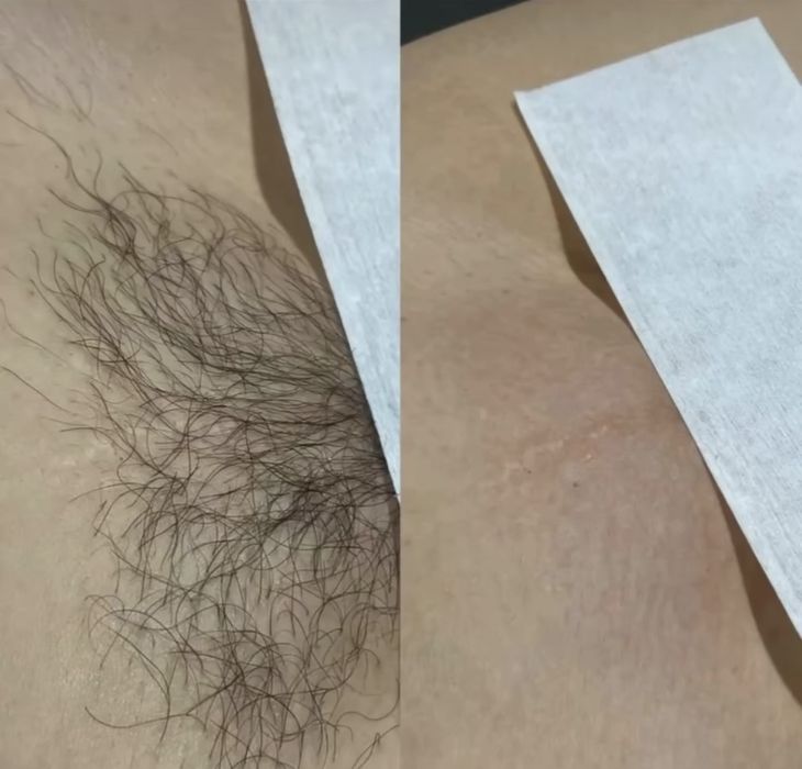 Шугаринг, восковая депиляция