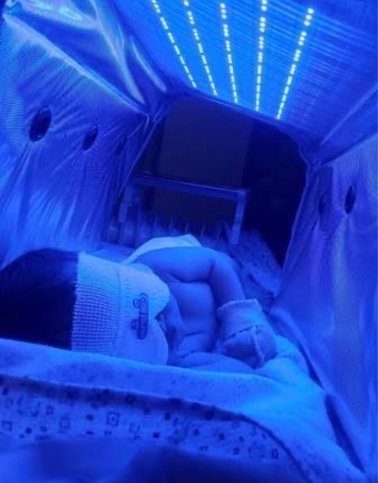 Сарикликни даволаш учун фотолампа ижарага берилади