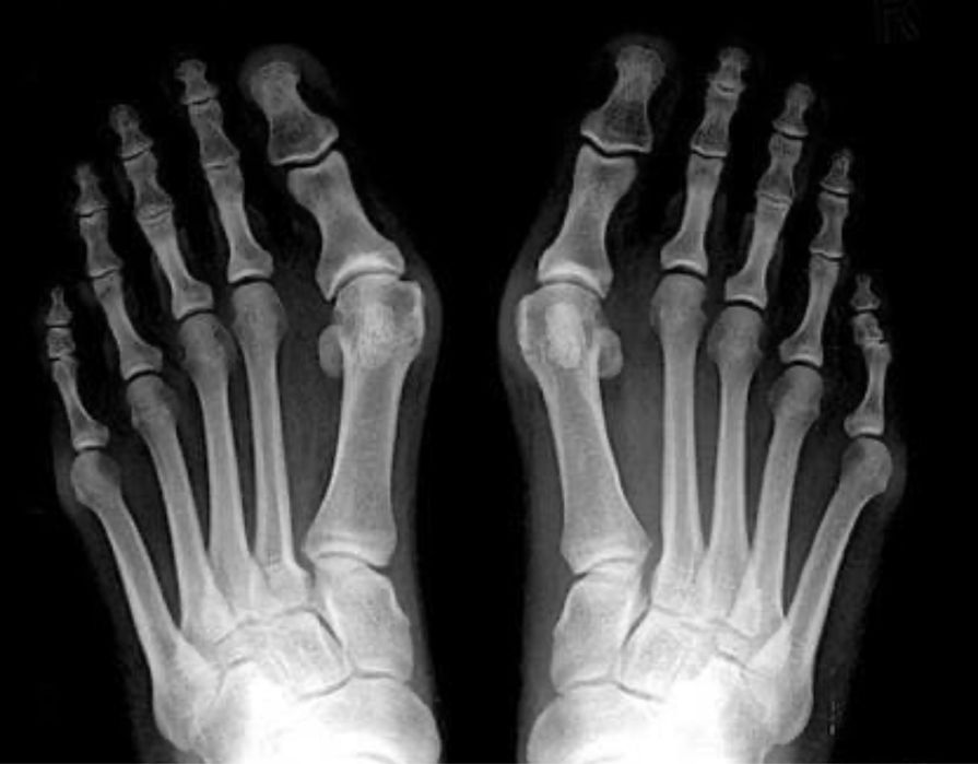 ТОП Цена Ортеза Шина за изпъкнали кокалчета Халгус Вагус Бунион