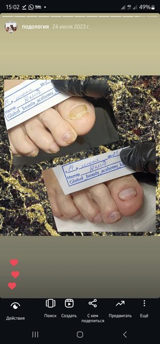 Педикюр титановая нить подолог