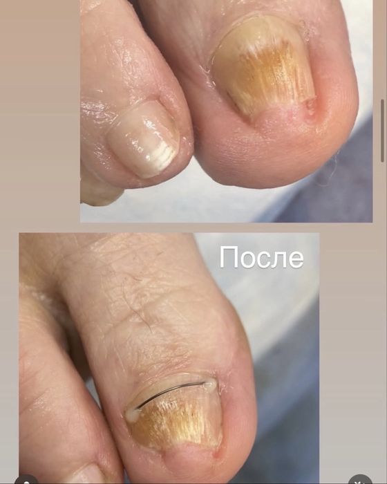 Подолог.Бородавки.Вросший ноготь