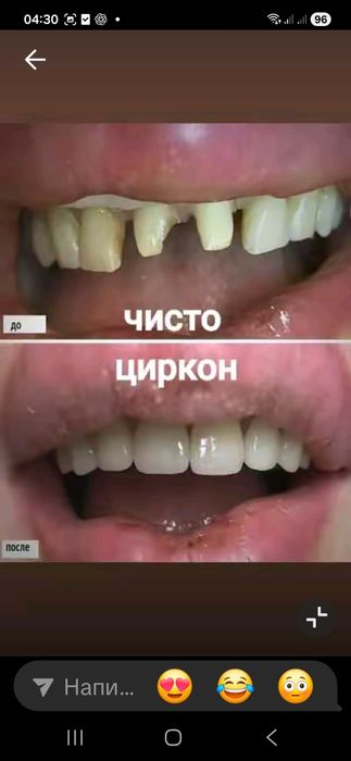 Стоматология церкон металокерамика