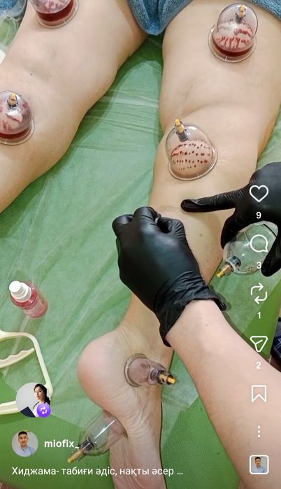 Массаж хиджама иглотерапия