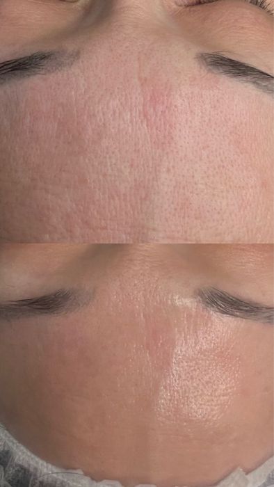 Врач Дерматолог-Косметолог |Чистка лица | Профессиональные процедуры