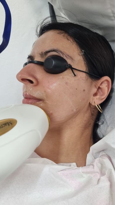 Epilare definitiva laser diode