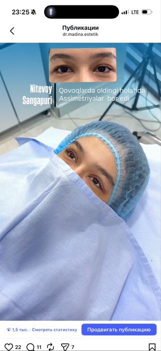 -50% CHEGIRMADA Qovoqlar Blefaroplastikasi