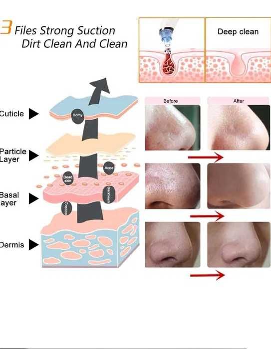 Вакуумен уред за почистване на лице и премахване на черни точки