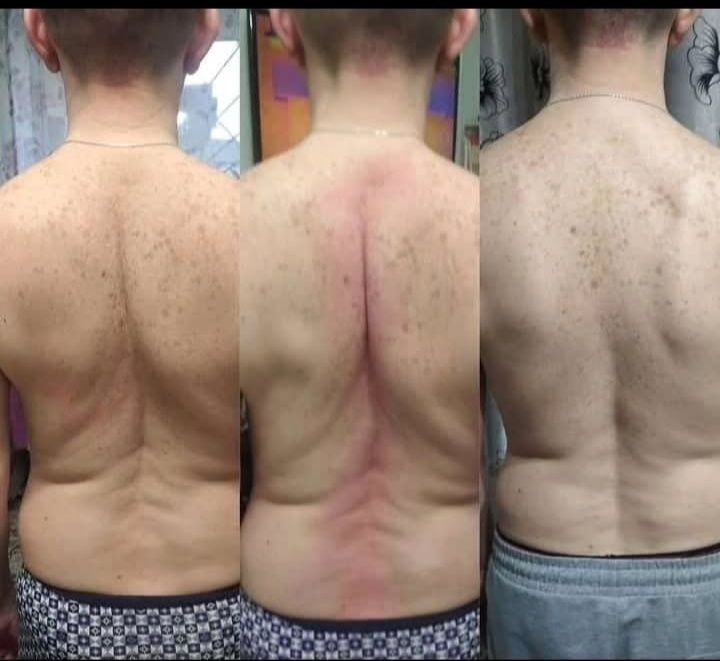 Остеопатия массаж хиджама