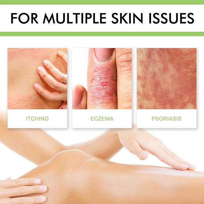 ZB Healmusz*2 bucati-Crema psoriazis, dermatita, prurit, antibacterian