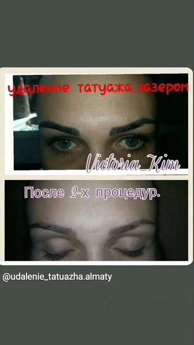 Удаление татуажа лазером 5000т