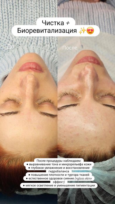 Нужна Модель на косметологические процедуры