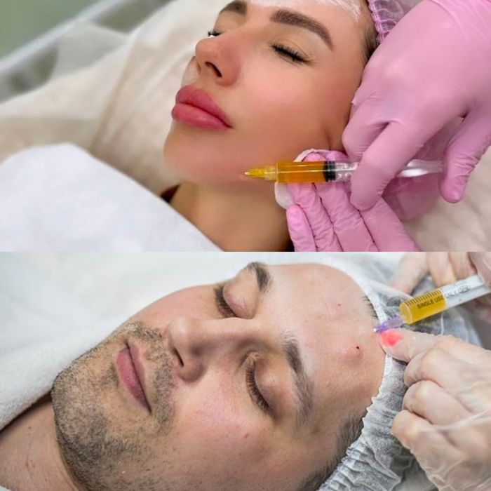 Плазмолифтинг лица, Акция плазмолифтинг лица Алматы