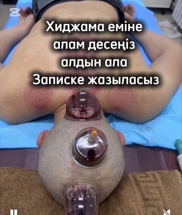 Хиджама, Пиявки Массаж емдері