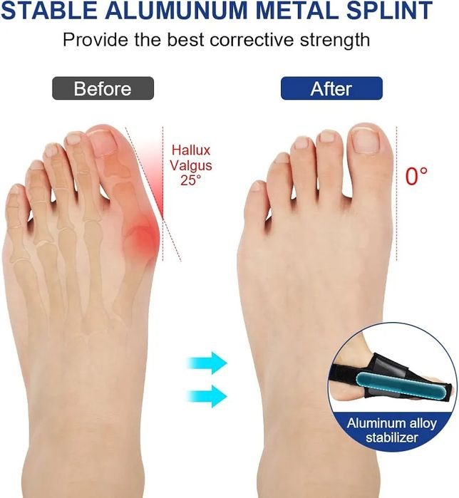 К-кт 2бр шина за корекция на изпъкнало кокалче Hallux Valgus