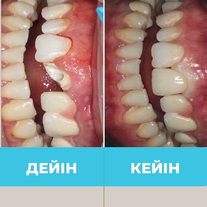 Алматы тіс емдеу , стоматолог