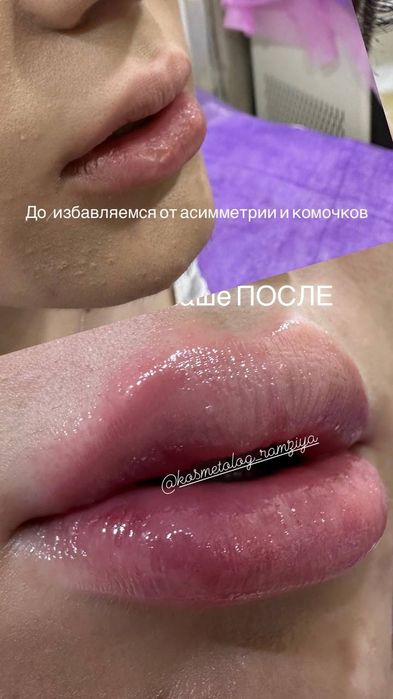 Косметологические услуги (мужчины и женщины) ,фуллфейз ботокс, губы
