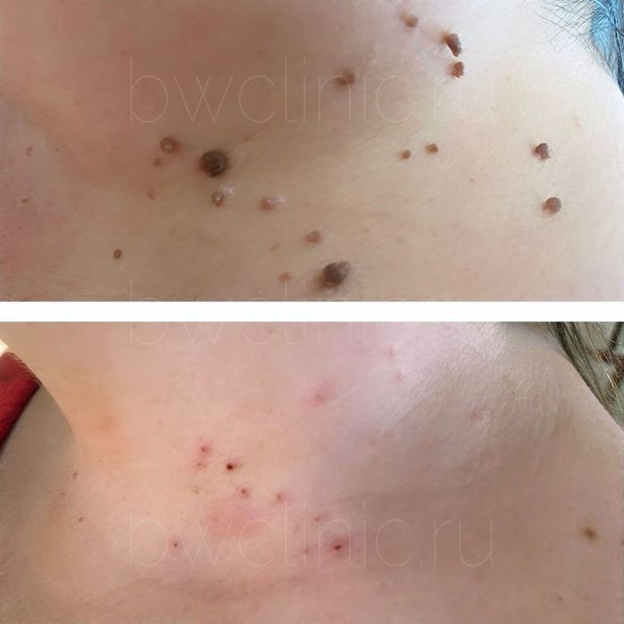 Процедура удаления папиллом и бородавок