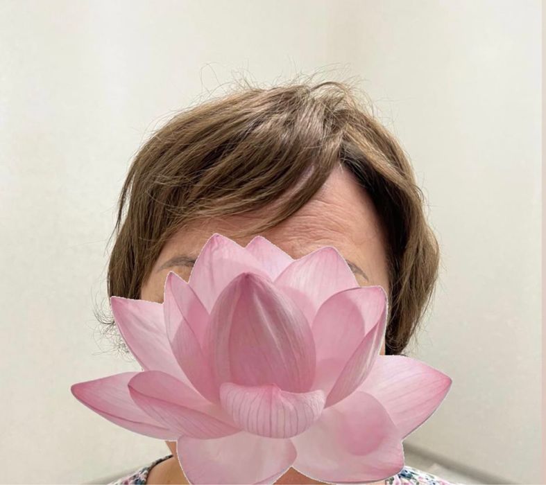 Теменная накладка