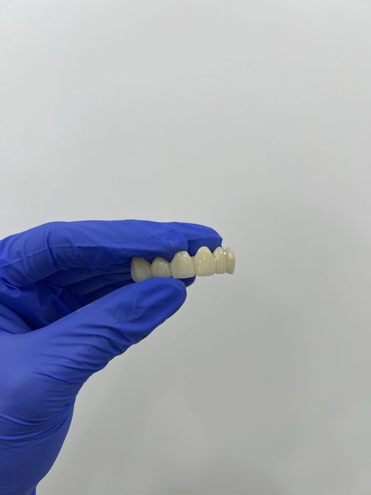 Цирконий / E-max за 2–3 дня | Luminora Dental