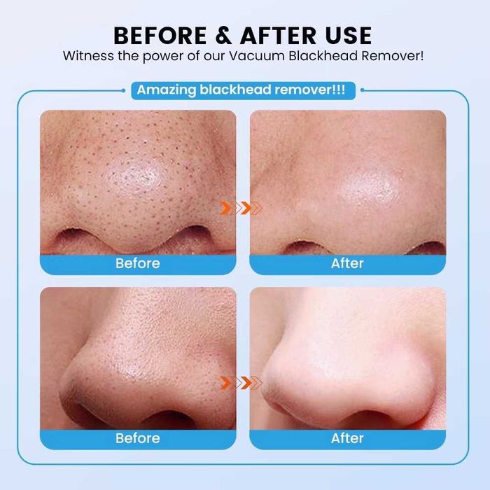 Топ цена! Нов вакуум уред за почистване на лице с 4 приставки