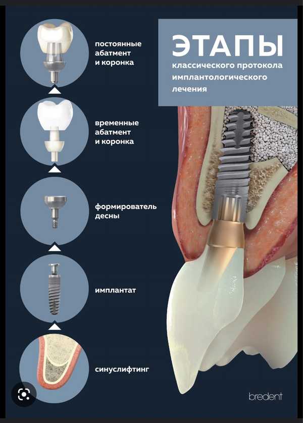 Денталпедия. Глава 4. Имплантация зубов - все что нужно знать пациенту. ZiZi Den