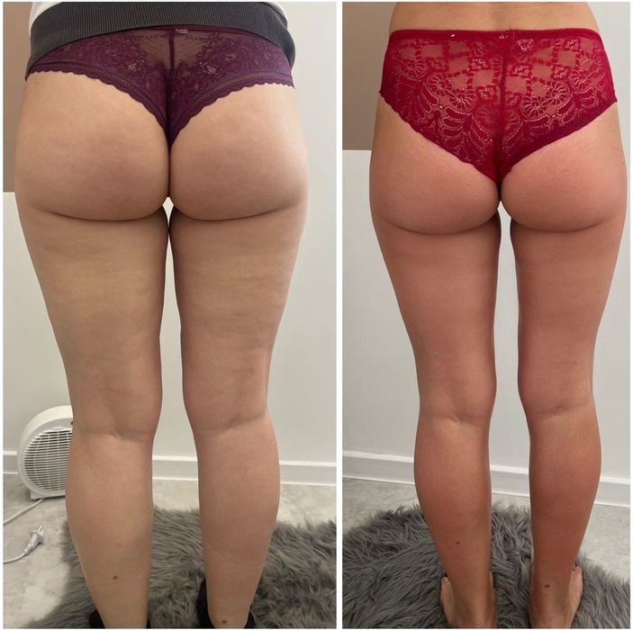 8D Endo Roller-професионален апарат за редуциране на целулит и стягане