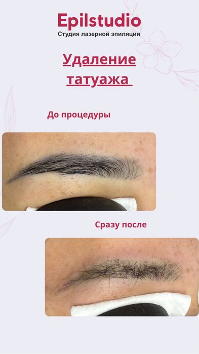 Удаление татуажа
