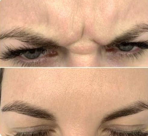 Ботокс,Траптокс,Гипергидроз.Botoks, Traptoks, Qùltiq terlash, gipergid