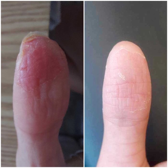 Мехлем против Гъбички по кожата / Дерматит / Екземи