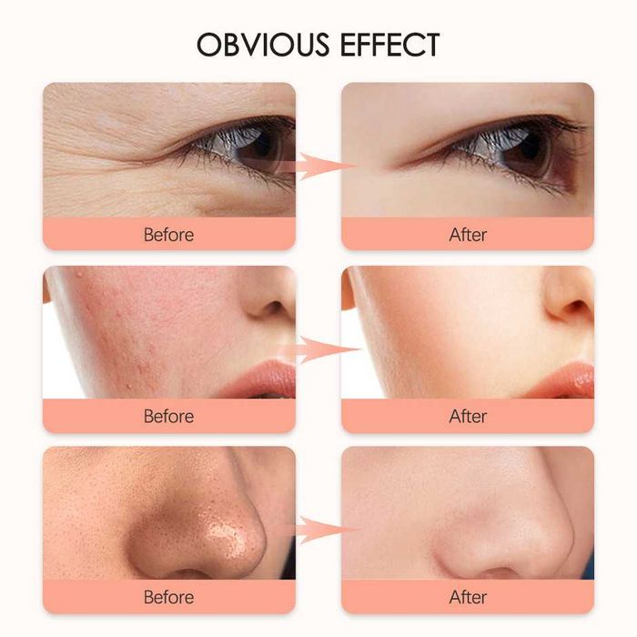 БЕЗЖИЧНА LED маска за лице за светлинна терапия, Маска анти ейдж, акне