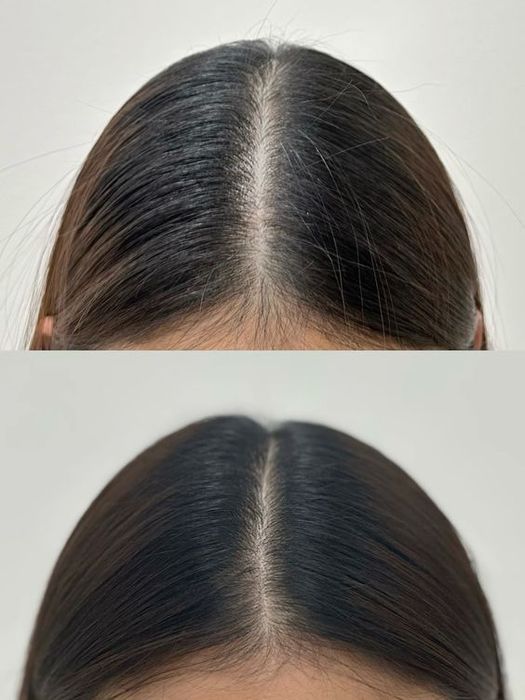 Soch tushishi yoki alopesiya bilan qiynalayapsizmi?Shifokor dermatolog
