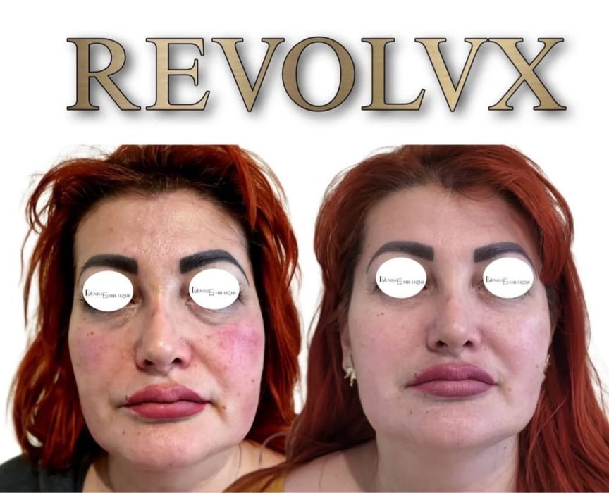 Vând aparat profesional de remodelare corporală și facială REVOLV-X