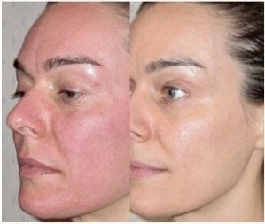 Dermapen Aparat microneedling Mezoterapie set complet