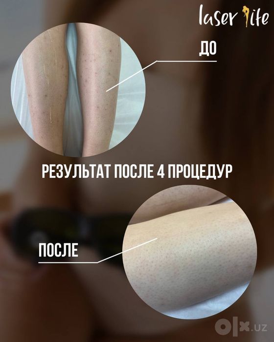 Лазерная эпиляция