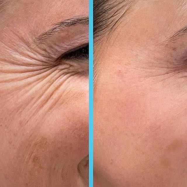 Естественное омоложение холодной плазмой