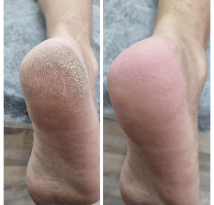 Подолог,установка нити.мазоли