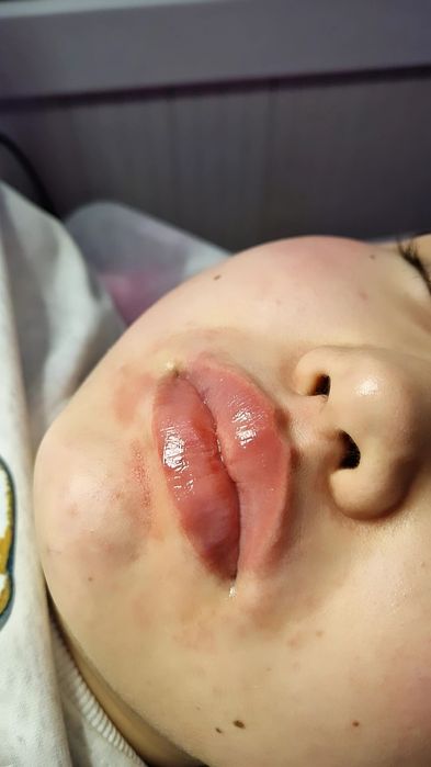 Увеличение губ Косметолог