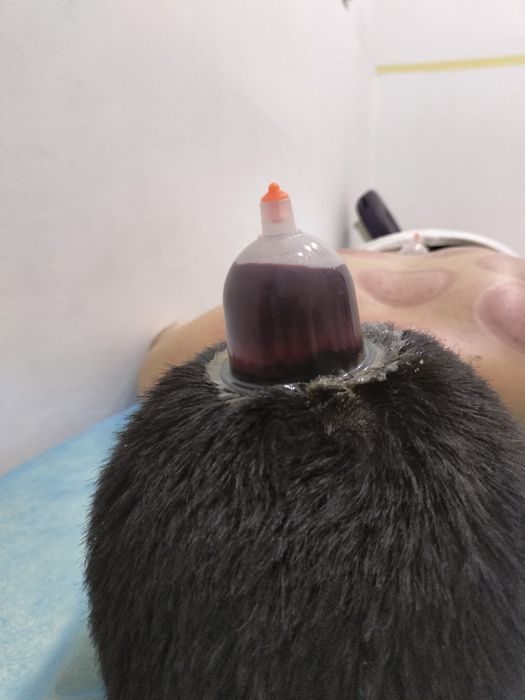 тиббий зулуклар медицинский пиявки гирудотерапия