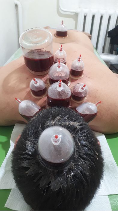 Хиджама и шертпе на выезд в городе Алматы