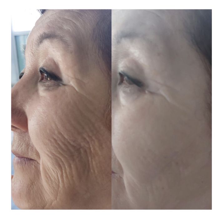 Ультрафонофорез аппарат